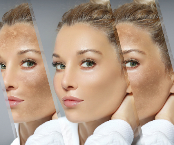 اسباب تصبغات البشرة